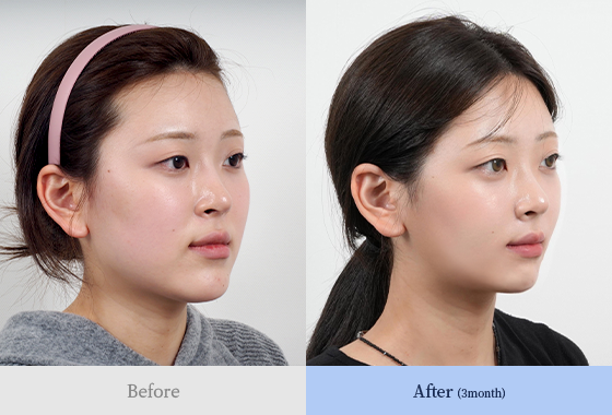 양악 + 턱끝 + 광대